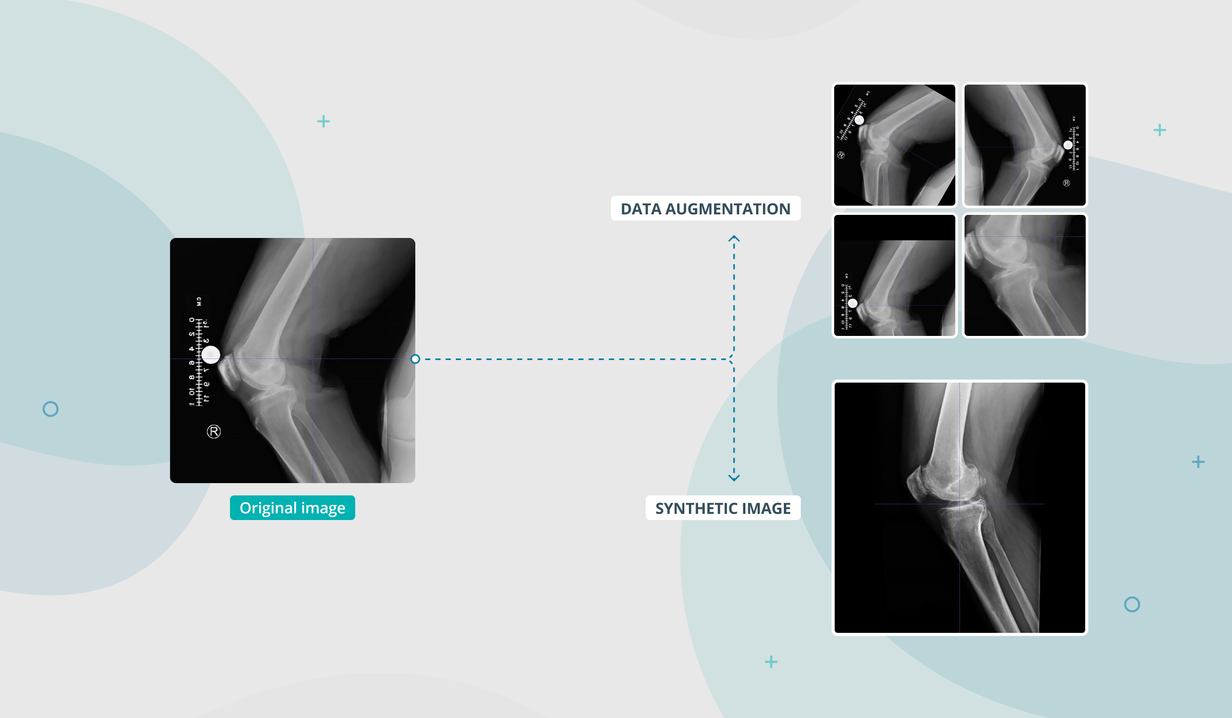 Data_Augmentation_Orthopedics_Xray