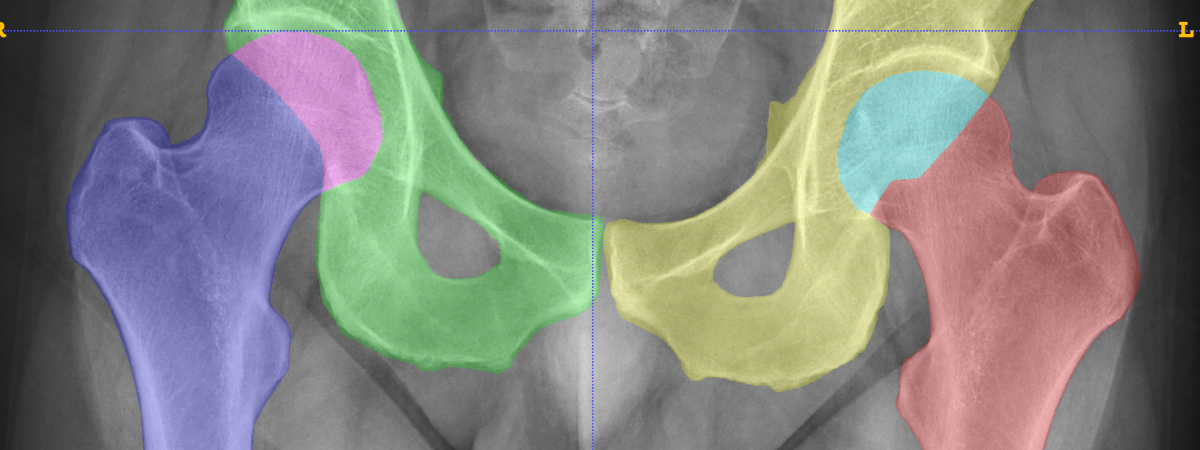 Hip Segmentation-1