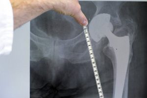 bone implant meassure