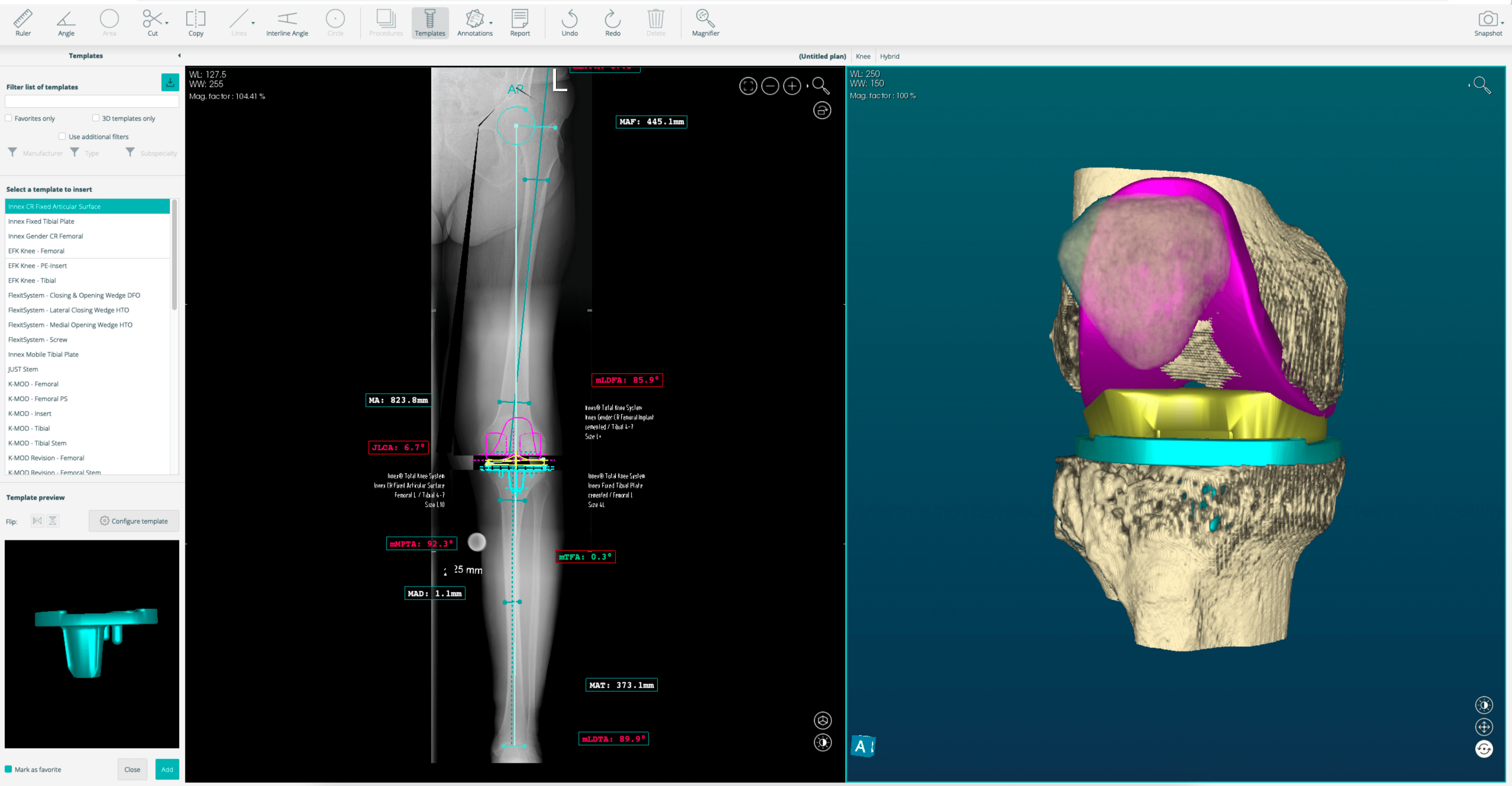 Templating PeekMed-2-1