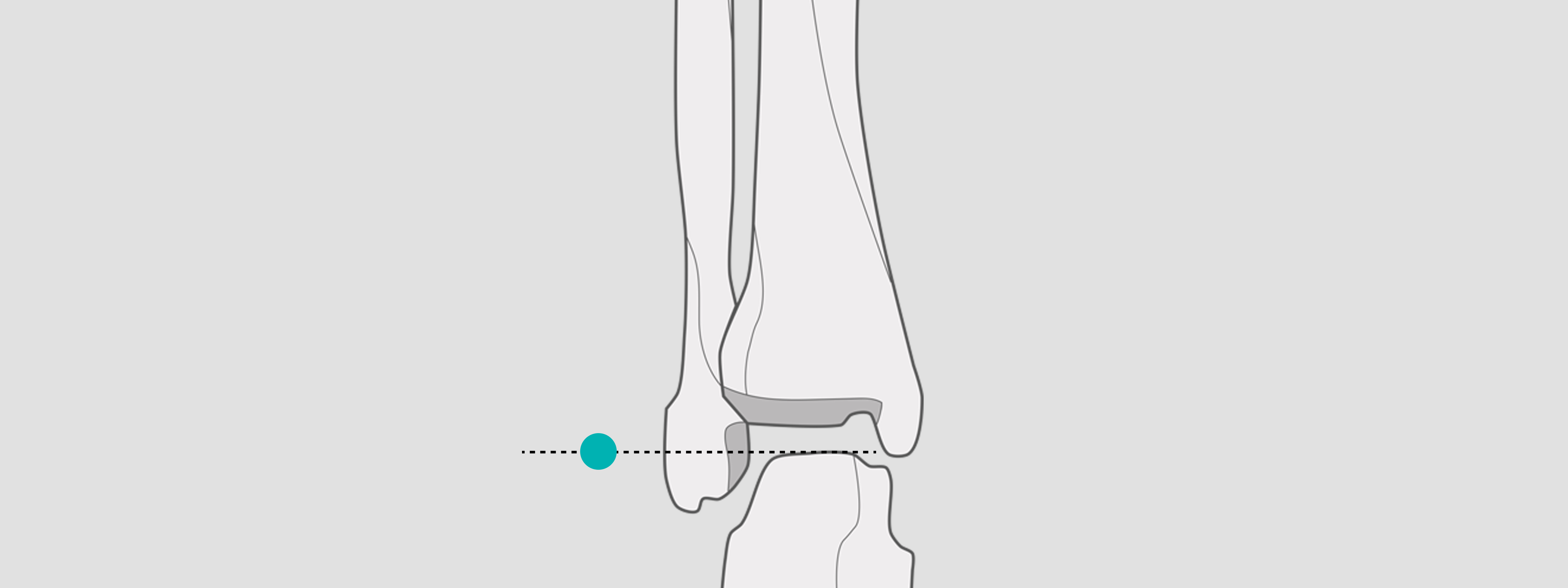 X-ray Calibration - ankle
