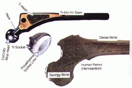 Orthopedics Implants Materials: femoral implant vs human femur