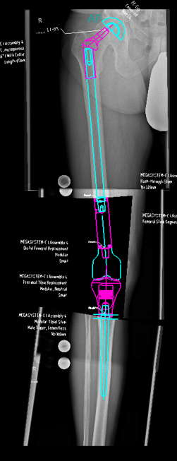 modular implant knee