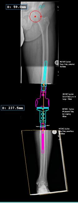 MUTAR in a total knee replacement