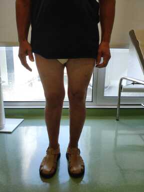 Patient Standing After Double Knee  Osteotomy