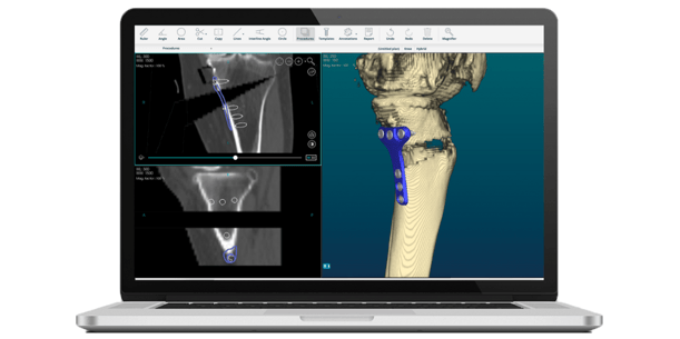 Planning  Osteosynthesis with PeekMed
