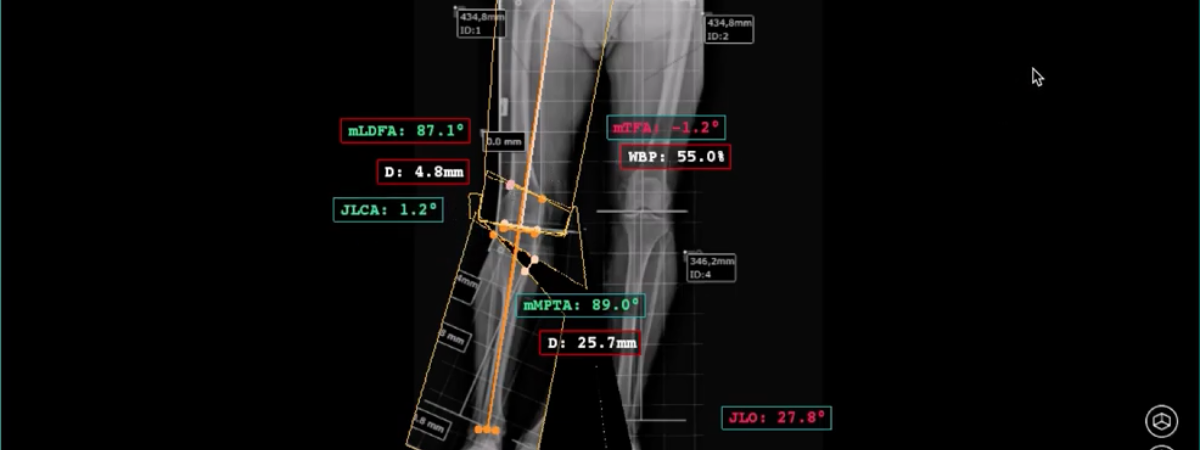 Planning a Double Knee Osteotomy