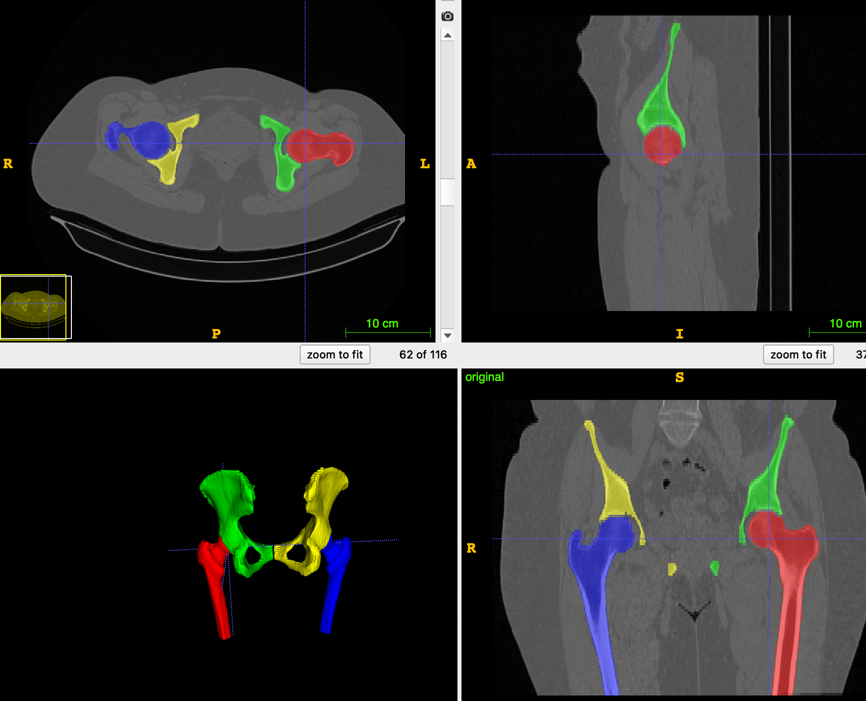 Segmented Images of a Hip
