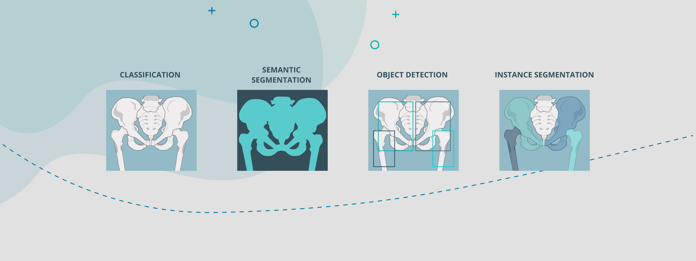 Types of Bone Segmentation