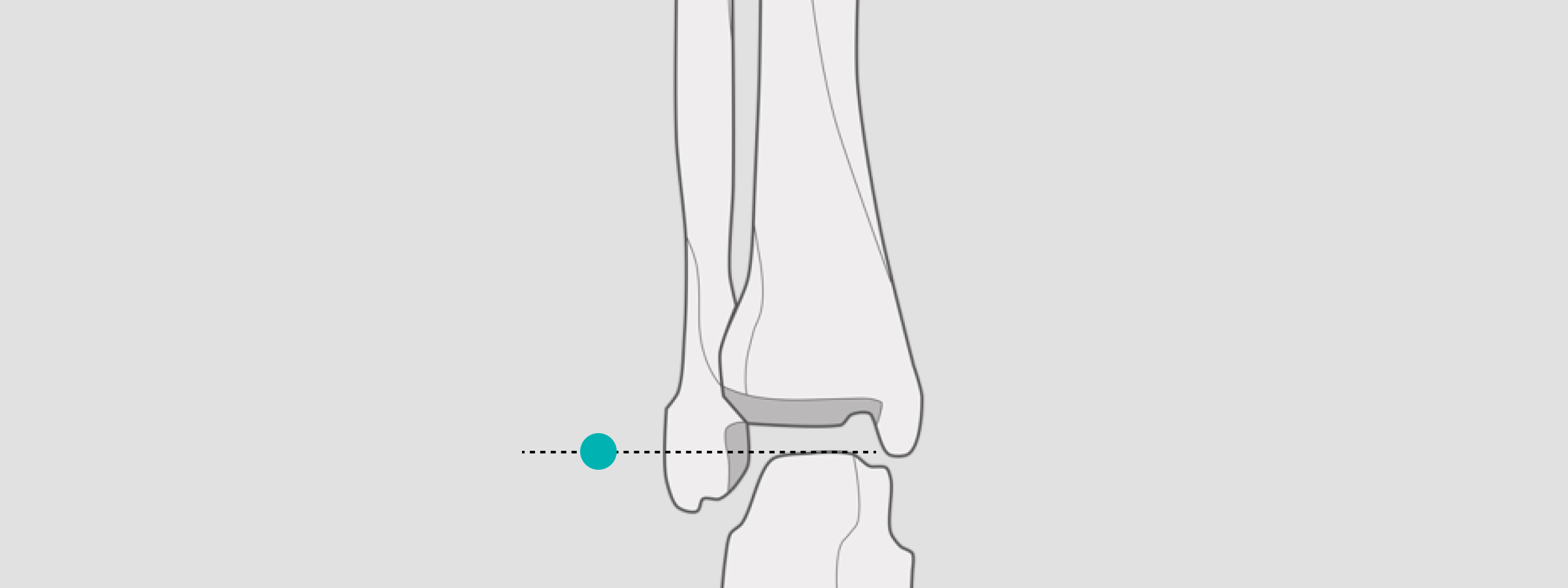 X-ray Calibration ankle