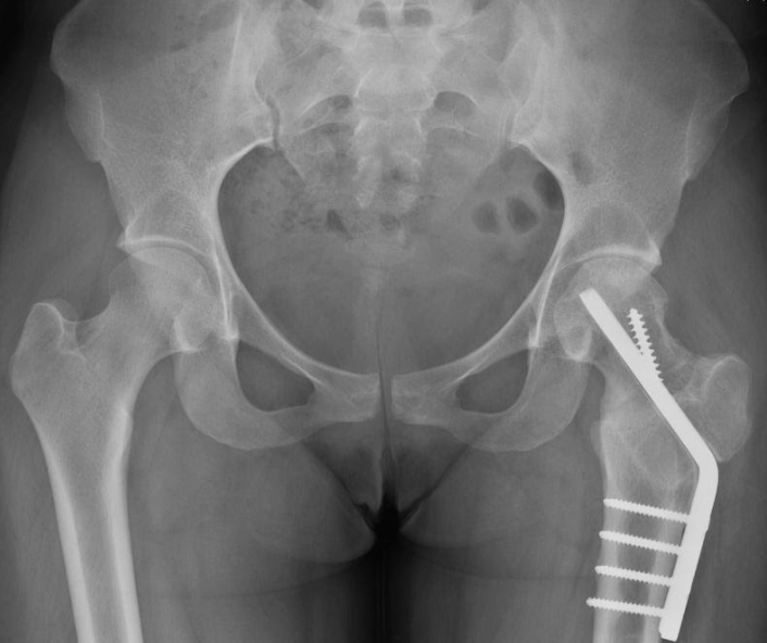 X-ray after surgery hip
