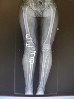 X-ray ptient double knee surgery
