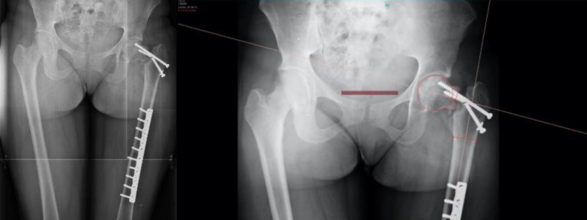 hip deformity x ray