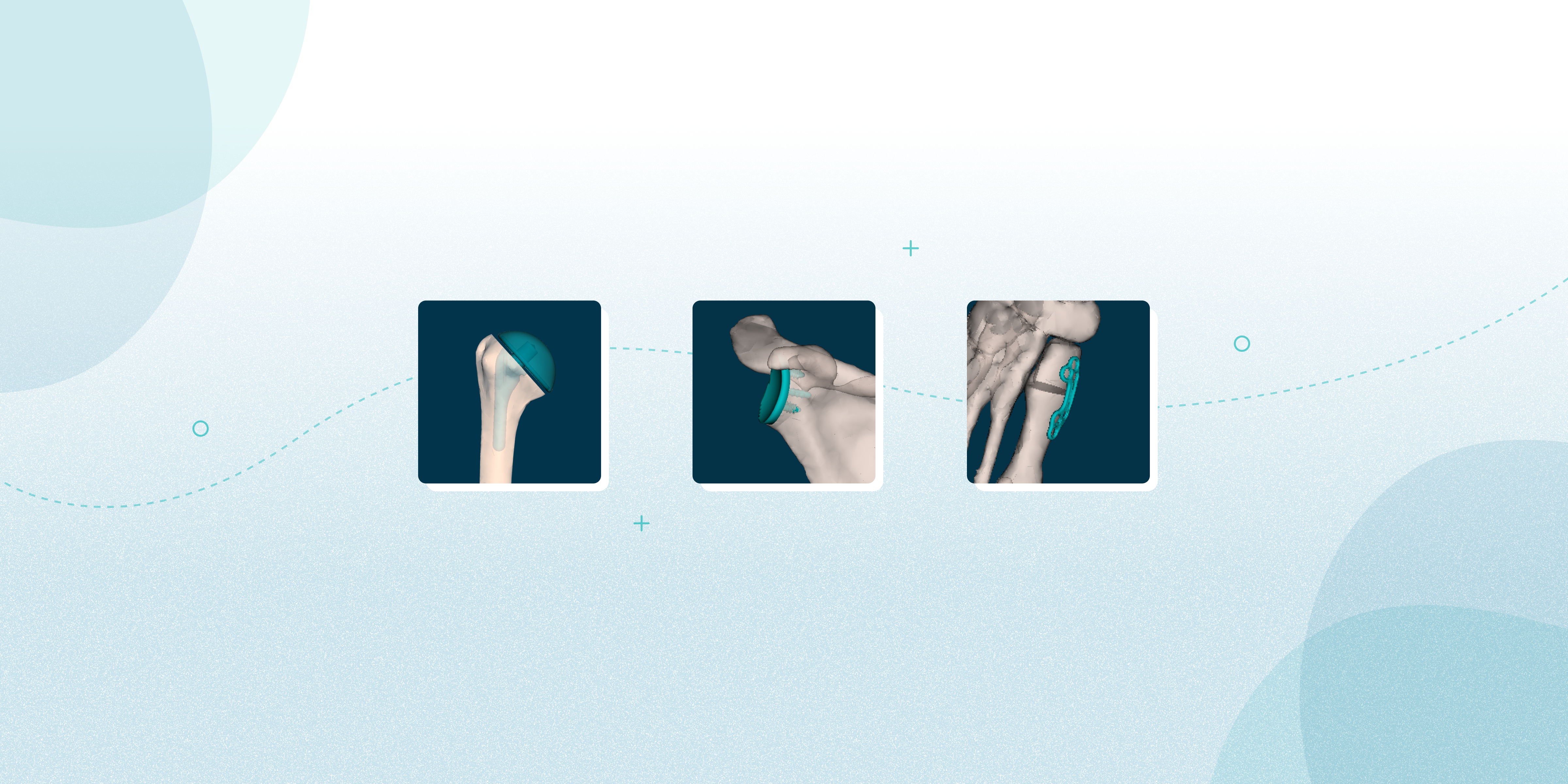 Picture of From Manual to Automatic: The Power of Orthopedic Templating