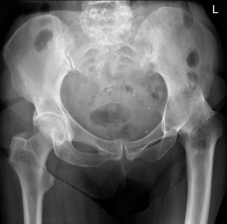hip-arthroplasty-templating-improve-the-procedure-with-a-digital-approach